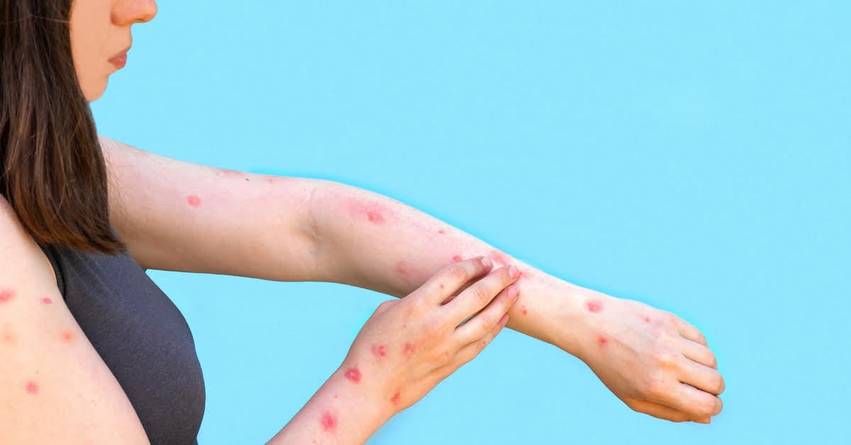 Rio de Janeiro registra primeira morte por varíola dos macacos