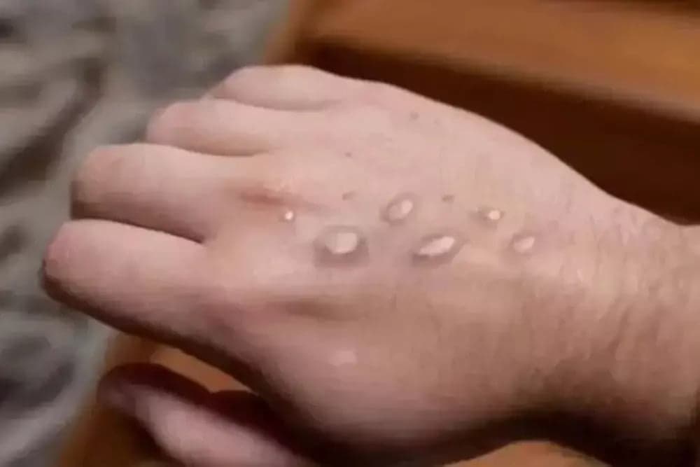 Amazonas registra mais cinco casos de varíola dos macacos