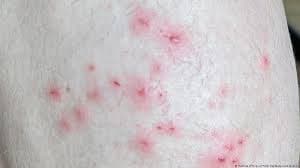 Sobe para 40 casos confirmados da varíola dos macacos no Amazonas