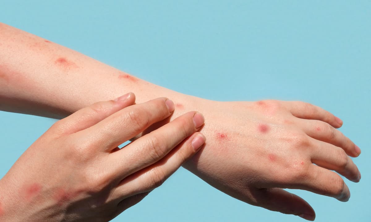 FVS-RCP confirma mais 11 casos de Monkeypox no Amazonas