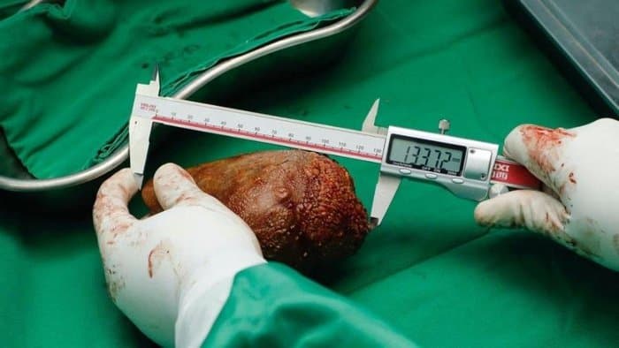 Maior pedra de rim do mundo é extraída de paciente no Sri Lanka
