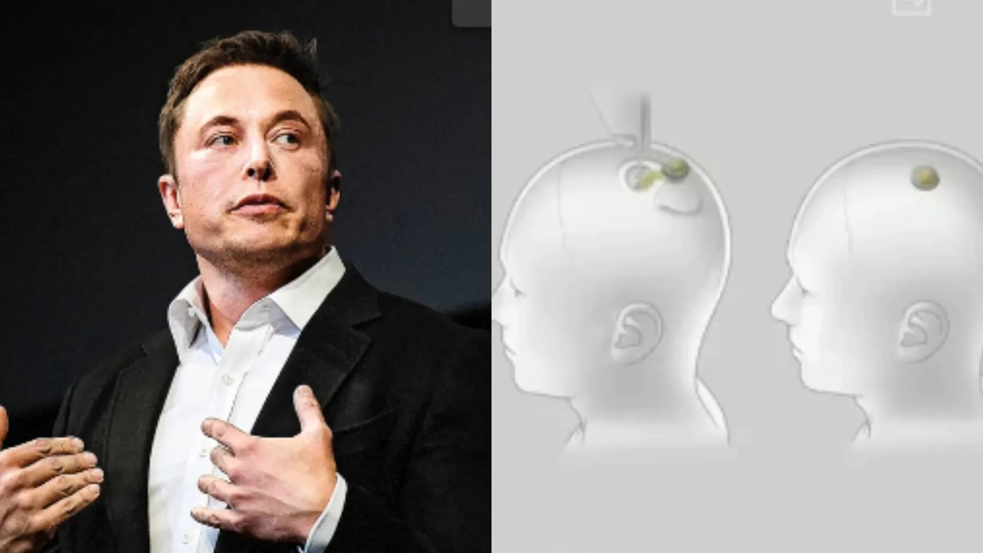 Elon Musk anuncia o primeiro implante de chip cerebral da Neuralink