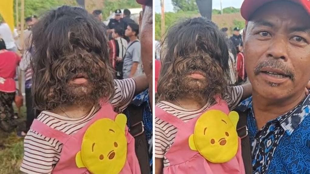 VÍDEO: Na Malásia, menina de 2 anos viraliza por síndrome rara