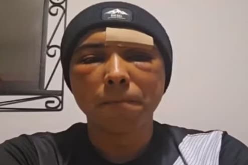 Brasileiro é agredido com taco na Irlanda: “Não tive tempo de me defender”