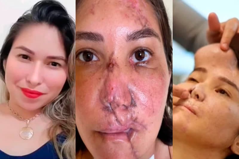 Mulher faz quatro cirurgias para reconstruir rosto após acidente no Pará