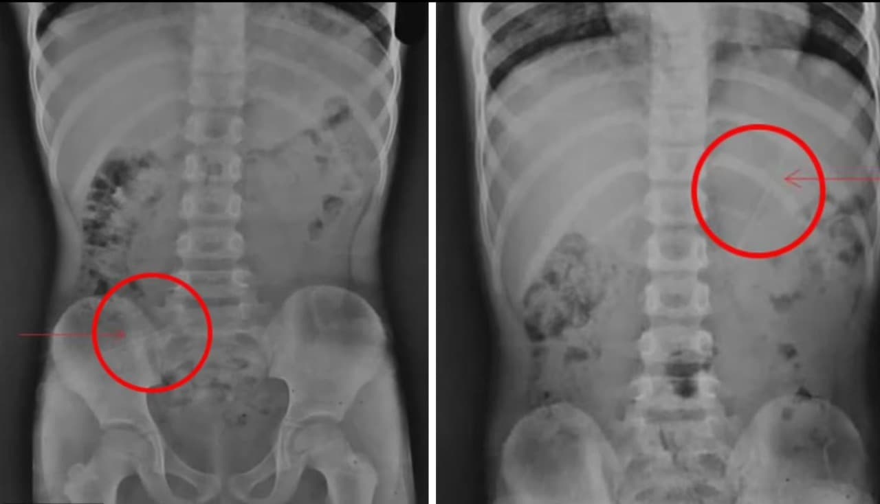 Criança de 7 anos sobrevive após engolir lápis de 10 cm, no Nepal