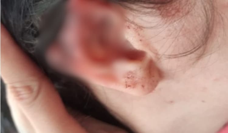 No interior de SP, homem é preso após arrancar pedaço da orelha da namorada durante briga