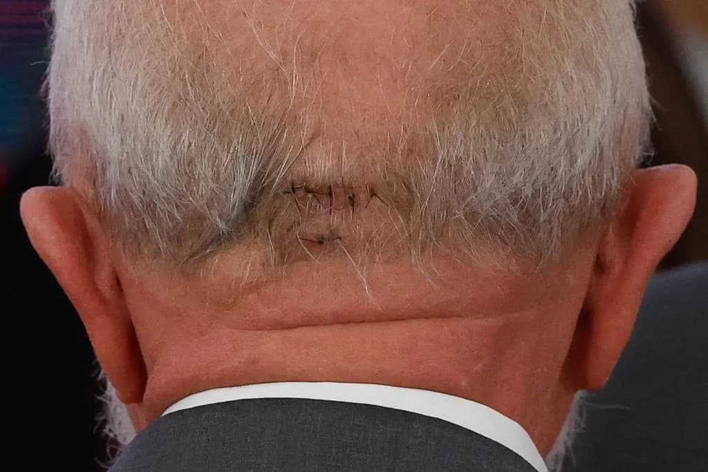 Médicos atualizam estado de saúde de Lula após cirurgia: &#8220;Estável, conversando e se alimentando&#8221;