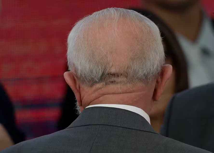 VIDEO: Lula já passou por novo procedimento e está acordado, diz médico