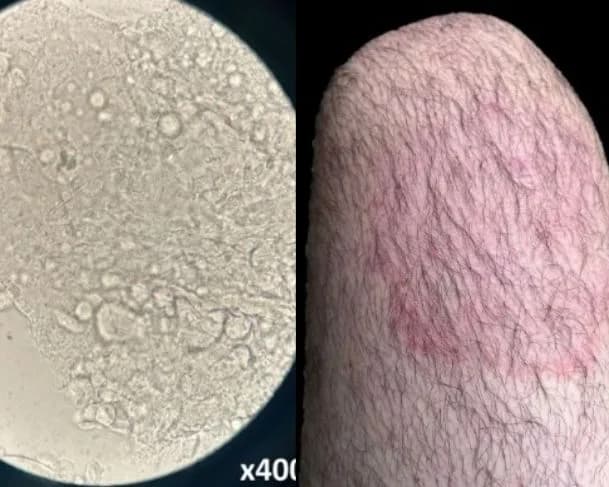 Micose extensa: infecção por fungo super-resistente é relatado no Brasil