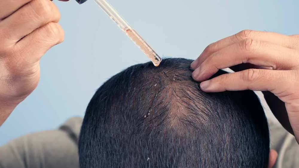 Anvisa emite alerta sobre riscos do uso de minoxidil por pais de bebês