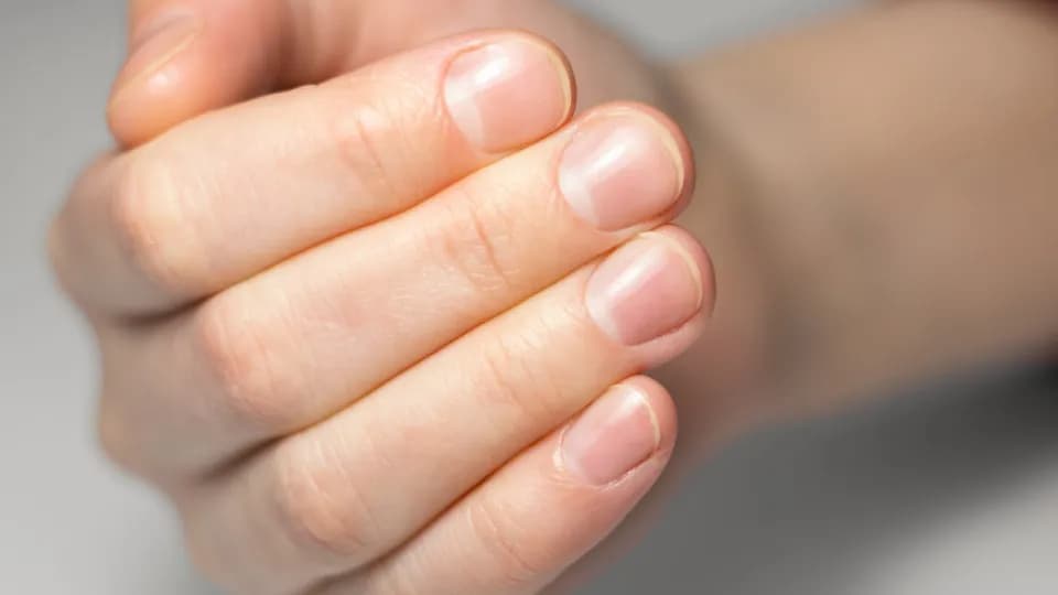 O que suas unhas revelam sobre sua saúde? confira alguns sinais