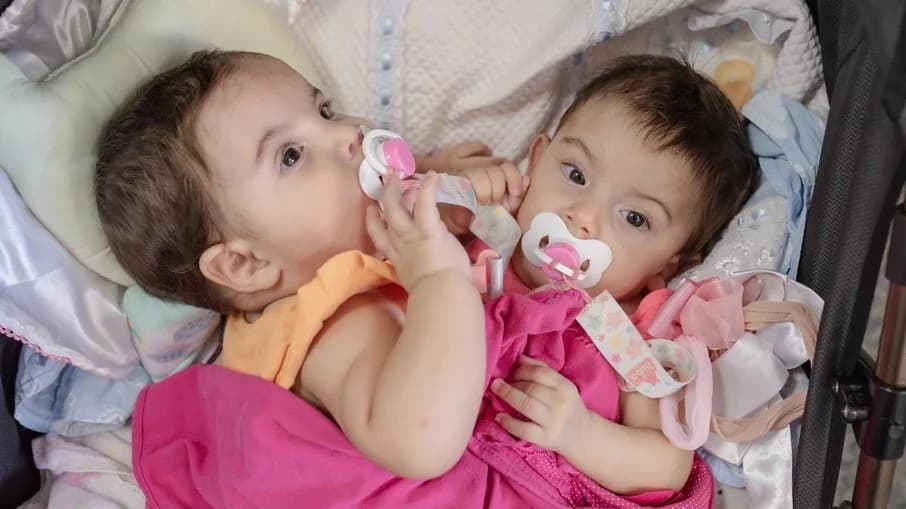 Goiás: gêmeas siamesas unidas pelo abdômen e bacia são internadas para cirurgia de separação
