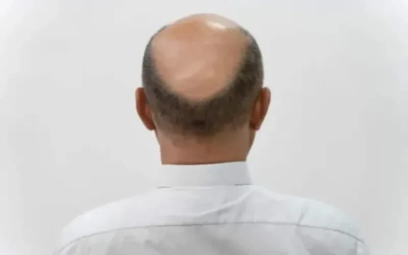 Queda de cabelo: pesquisadores criam produto que estimula o crescimento