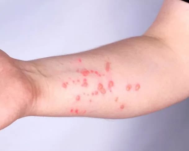 Amazonas já teve 35 casos de mpox confirmados em 2025