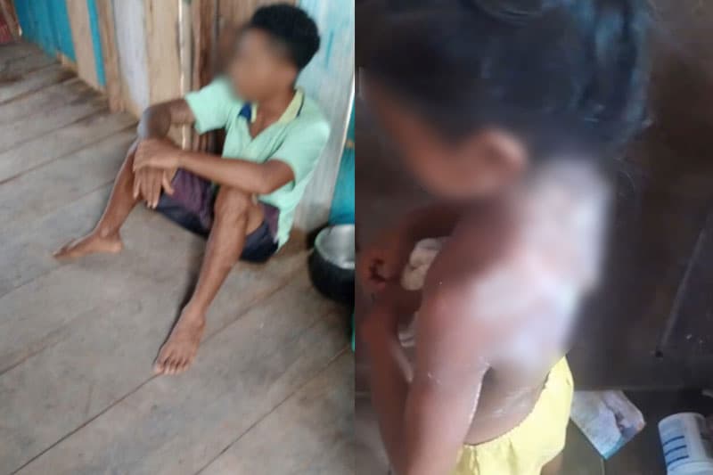 IMAGEM FORTE: padrasto é preso por queimar criança com mingau em Autazes