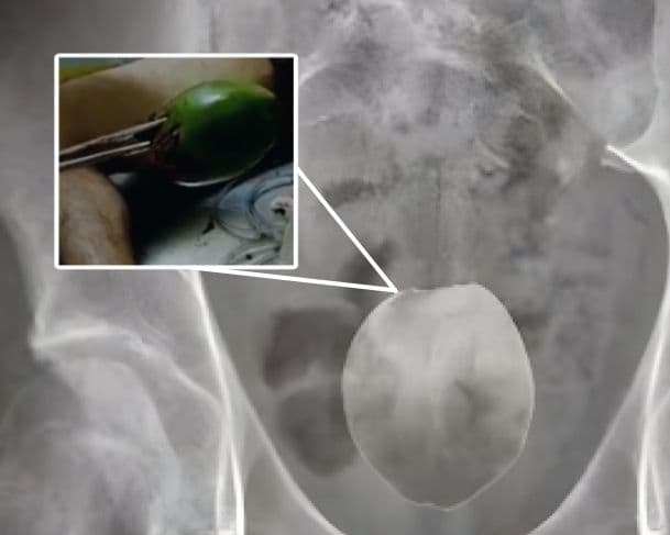 Médicos retiram coco de dentro do ânus de homem em MT