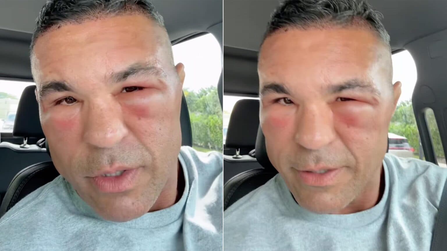 Vitor Belfort surge com rosto inchado após procedimento famoso; descubra qual