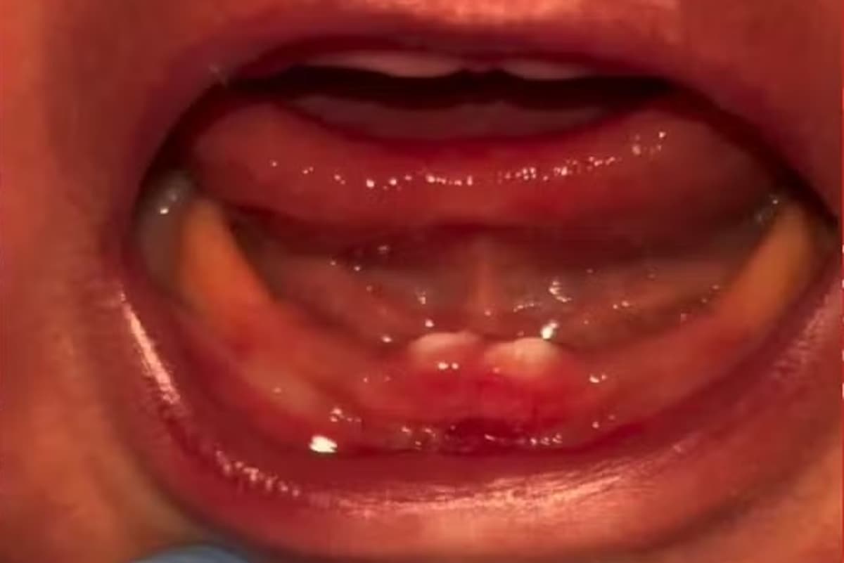 Bebê em Rondônia nasce com dentes e passa por cirurgia