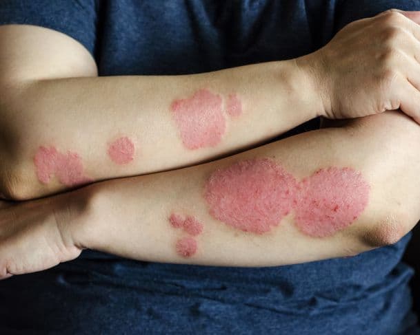 Janeiro Roxo: conhecida como lepra, hanseníase ainda atinge milhares de brasileiros