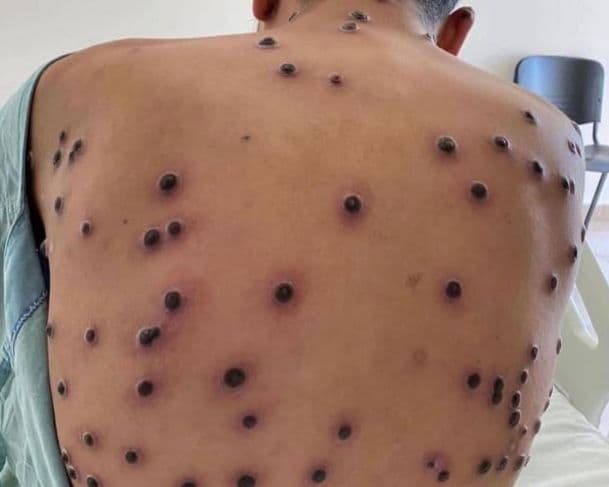 Médicos analisam possibilidade de epidemia de Mpox após aumento de casos no Brasil