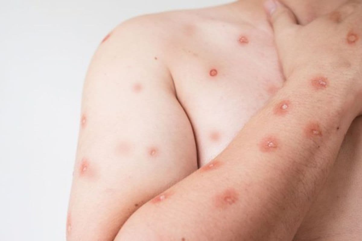 Mpox exige atenção, mas não se transmite como a Covid-19; entenda