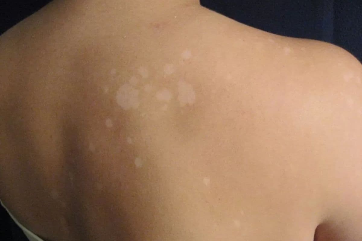 Saiba como identificar e qual o tratamento ideal para pano branco