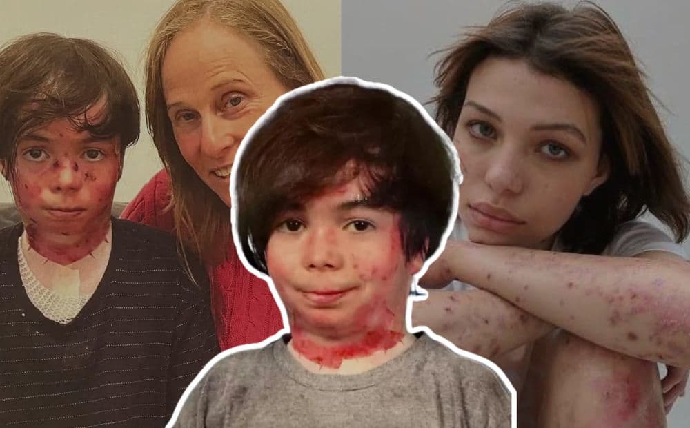 O que é a epidermólise bolhosa? Doença rara que vitimou adolescente de 14 anos