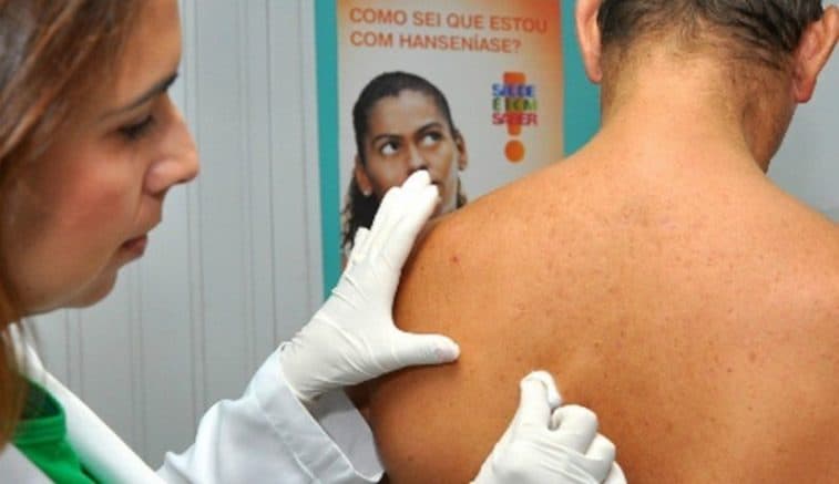 Hanseníase no Amazonas: Em meio a Covid, uma doença que passa despercebida