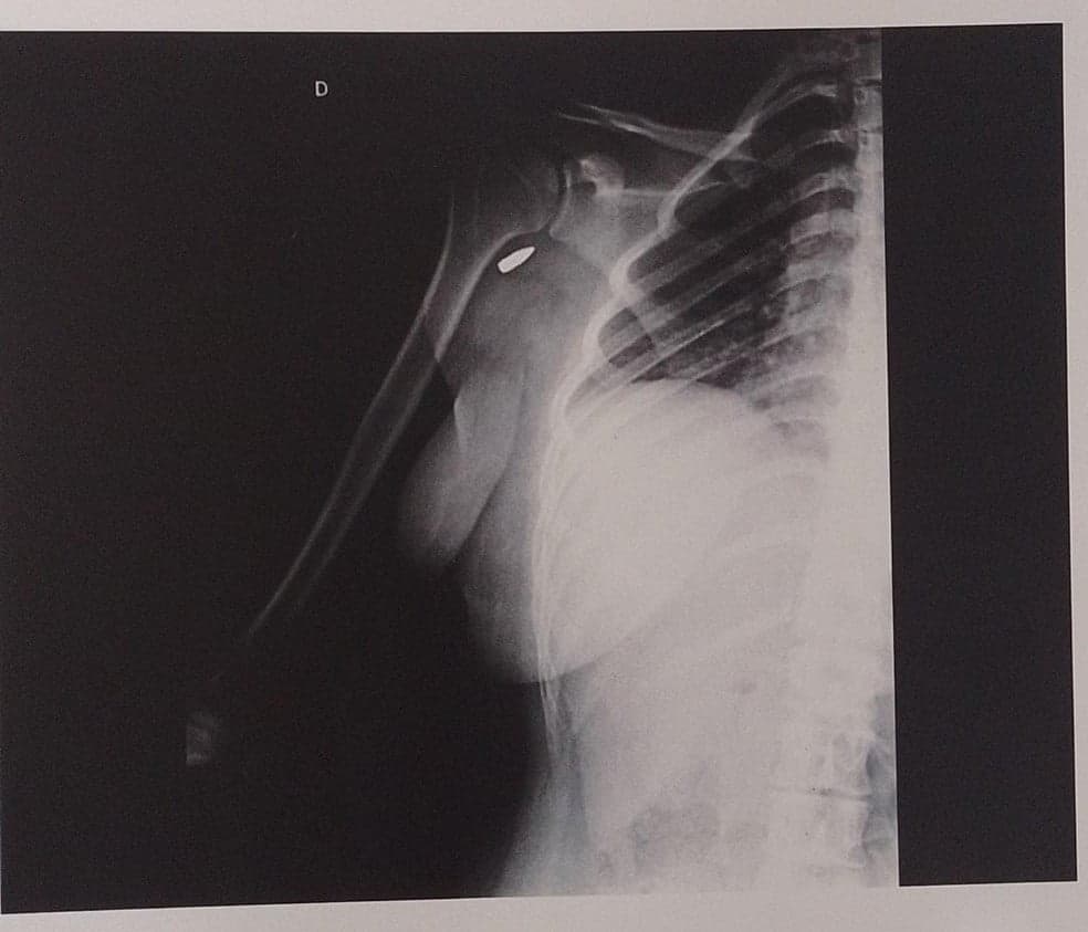 Jovem é atingida no braço por tiro no Rio de Janeiro e só percebe horas depois