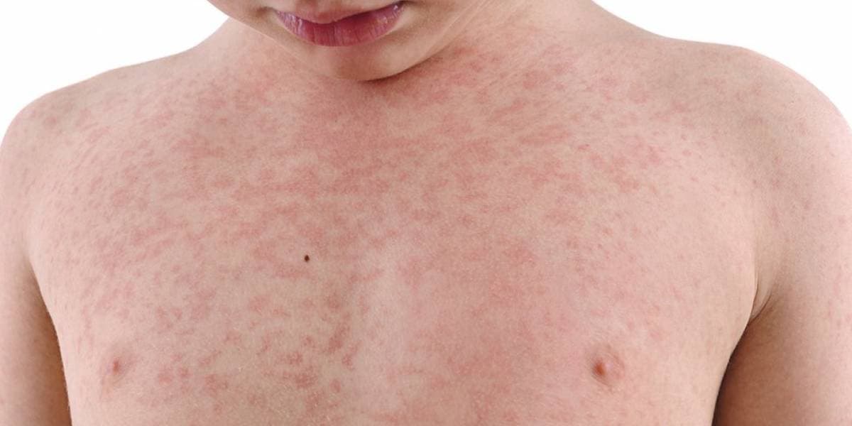 Primeiro caso de Sarampo é confirmado no Amazonas