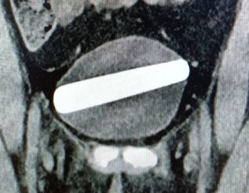 Mulher usa vibrador de cristal e objeto fica preso dentro dela