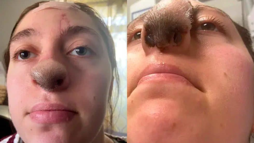 Jovem é mordida por cachorro e cabelo começa a crescer no nariz