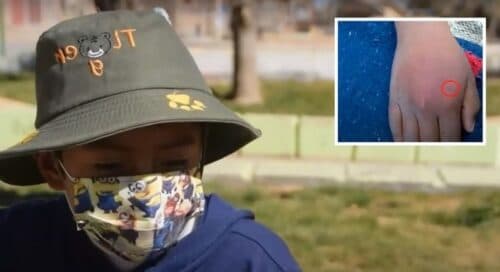 Criança deixa viúva-negra picar a própria mão para tentar virar o Homem-Aranha