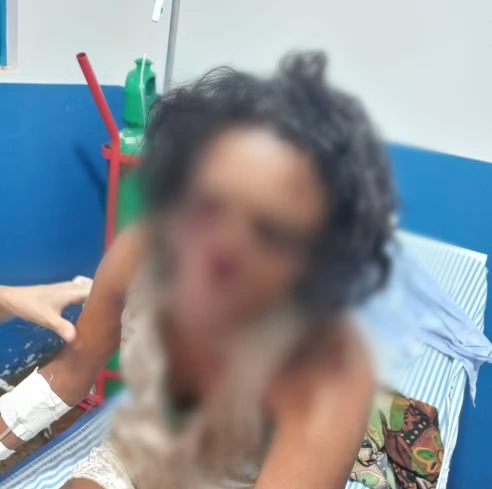 TO: Marido que arrancou nariz de esposa com mordida vai responder por tentativa de feminicídio