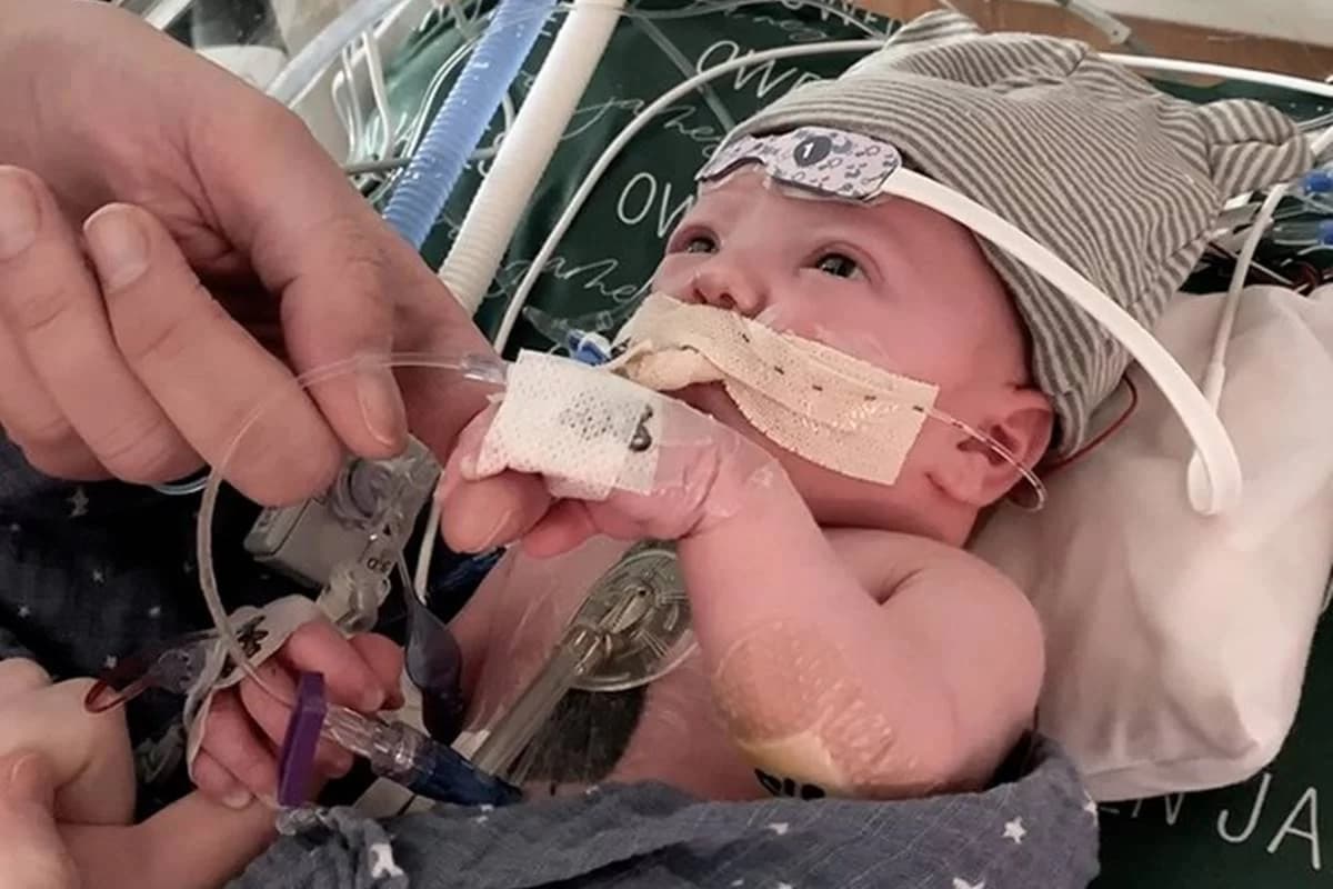 Recém-nascido recebe primeiro transplante parcial de coração