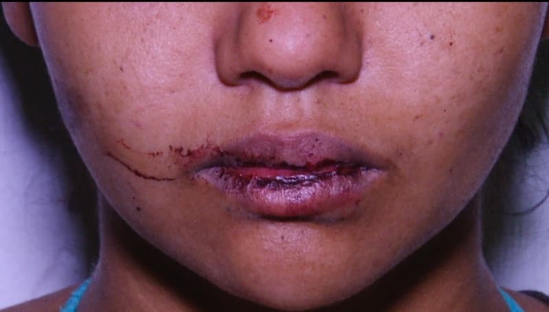 RJ: Mulher tem parte da língua arrancada pelo companheiro durante beijo