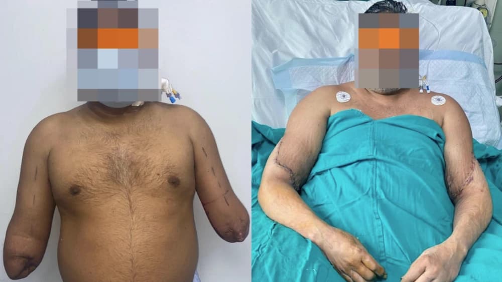 Atropelado por trem, homem recupera mãos após passar por transplante bilateral, na Índia