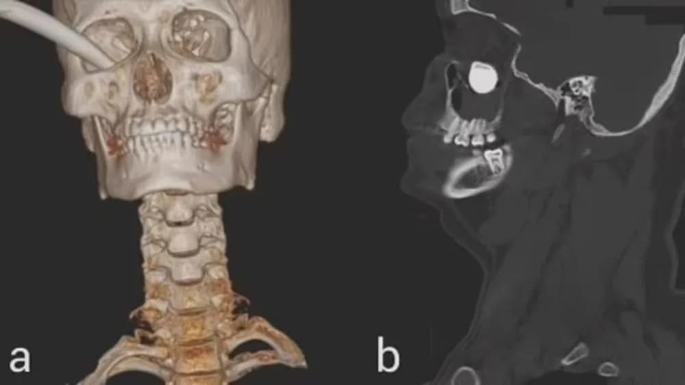 Alavanca de freio de moto atinge olho de jovem na Malásia