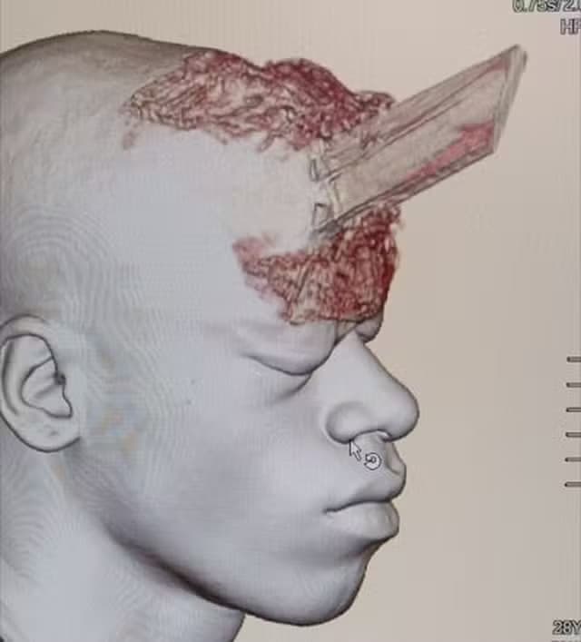 No RJ, pedreiro sobrevive após ter estaca de madeira cravada no crânio