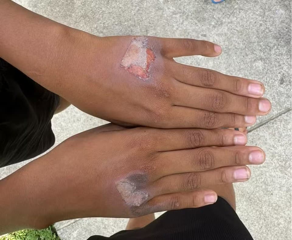 PE: Mãe é investigada por suspeita de queimar mãos do filho com chapinha: “Comeu iogurte sem permissão”