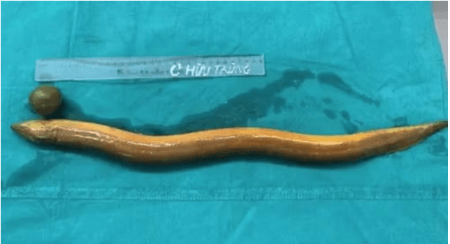 Homem é internado às pressas após enfiar enguia e limão no ânus