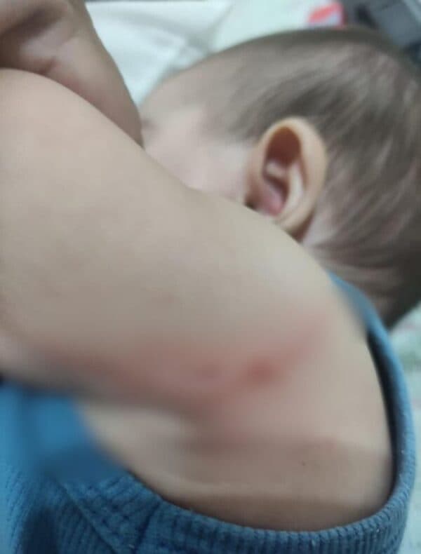 Bebê de 6 meses sofre corte profundo por linha de cerol em Manaus