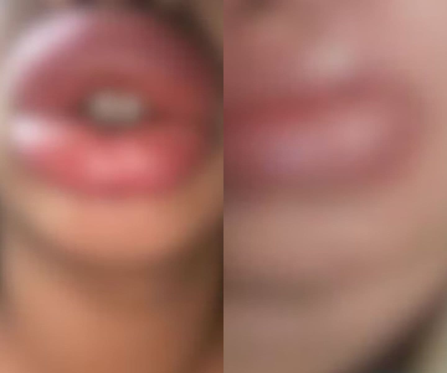 Falsa biomédica é investigada por deixar clientes com deformidades durante procedimentos estéticos no MT