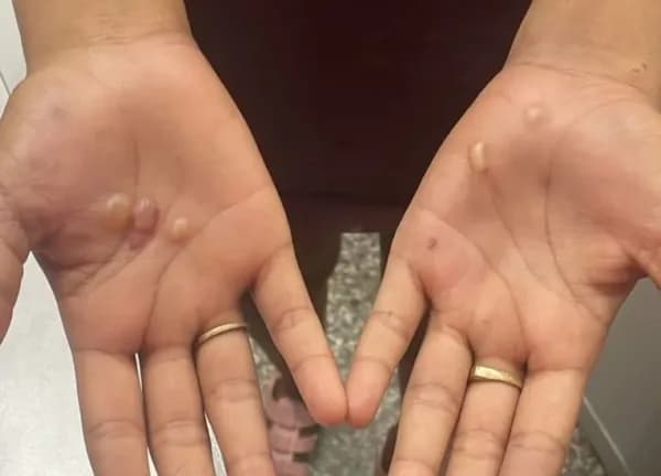 Após ser torturada e queimada, adolescente pula de moto em movimento para escapar de morte, em Manaus