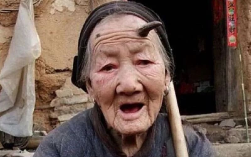 Bizarro: Mulher de 107 anos chama atenção por “chifre” de 10 cm na testa