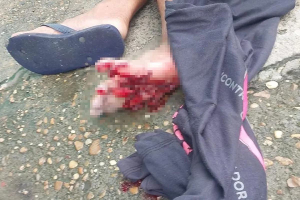 VÍDEO: Homem tem pé dilacerado ao pisar em catolé na zona Leste de Manaus