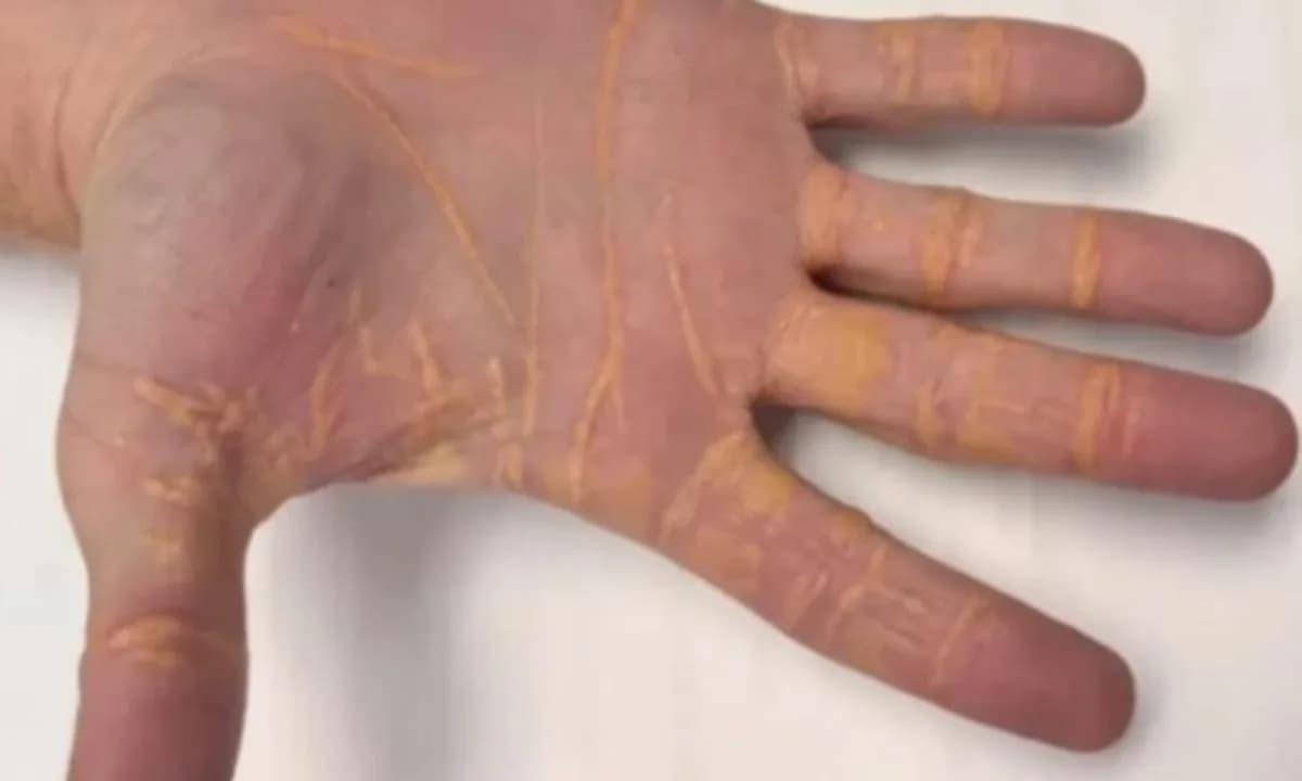 Homem desenvolve placas de colesterol na mão após dieta