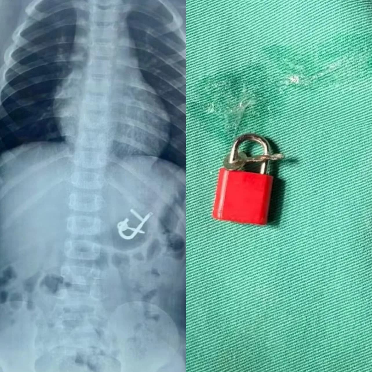 Criança engole cadeado com chaves em Pernambuco