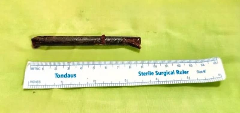 Jovem descobre pedaço de hashi enfiado no olho após 3 semanas de dores